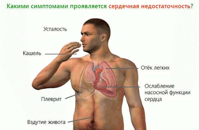 Кашель при сердечной недостаточности - Гипертонии нет