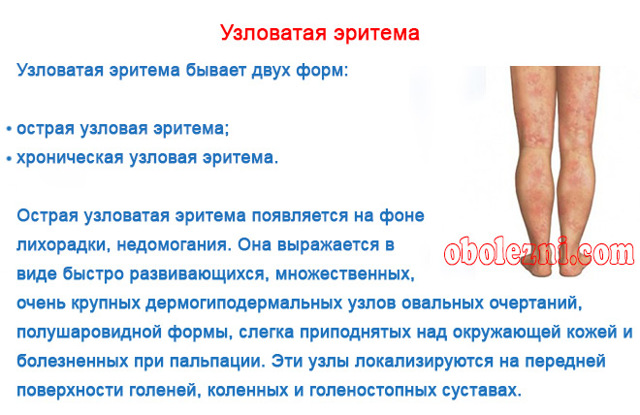 Узловатая эритема: фото, симптомы и лечение