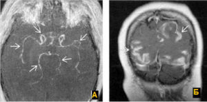 Васкулит мозга