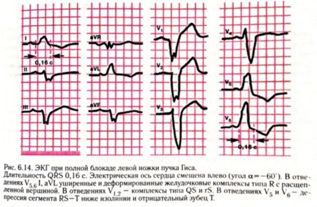 Блокада левой ножки пучка Гиса на ЭКГ (полная и неполная)