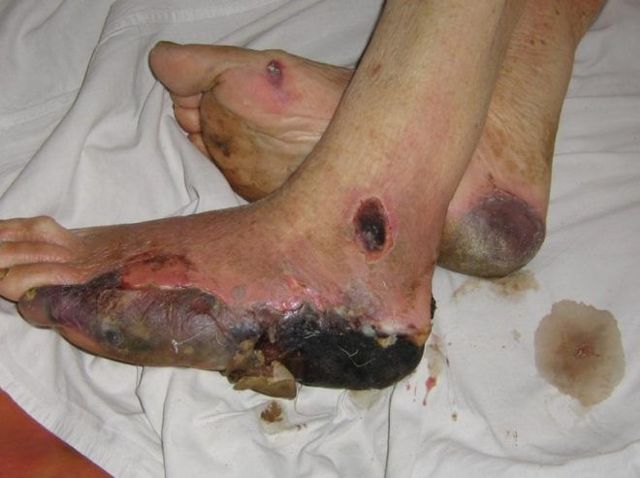 Облитерирующий эндартериит сосудов нижних конечностей - симптомы и лечение