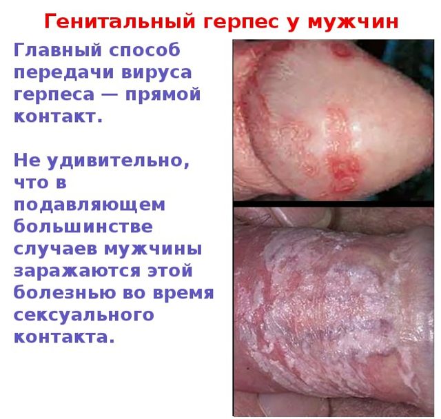 Генитальный герпес - фото проявлений у мужчин и женщин