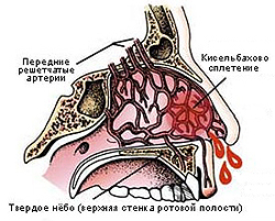 Кровь из носа: возможные причины, первая помощь и лечение