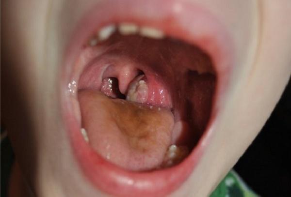 Паратонзиллярный абсцесс: лечение, фото, симптомы