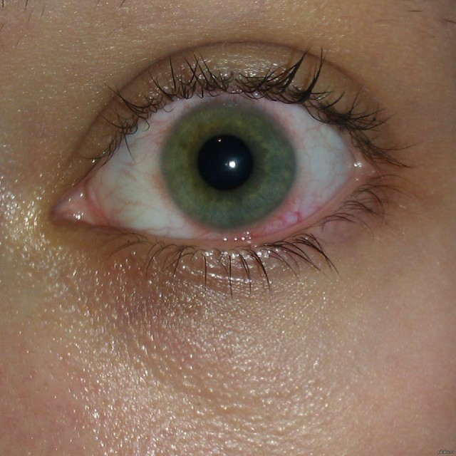 Почему лопнул капилляр в глазу, что делать?