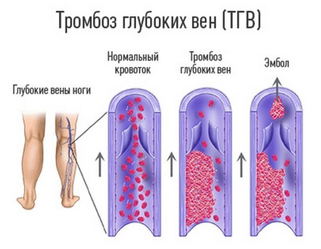 Тромбофилия мкб 10 - Cardiologiy