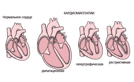 Кардиопатия сердца: симптомы, диагностика и лечение. Что такое кардиопатия у детей? Кардиопатия у детей и взрослых: причины, симптомы, лечение и возможные последствия.