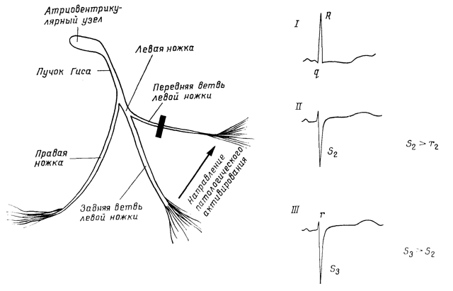 Блокада левой ножки пучка гиса на экг — Сердце