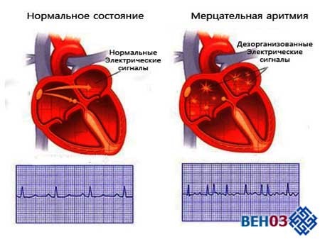 Лечится ли аритмия сердца
