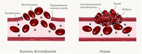 Болезнь Виллебранда у детей - презентация онлайн