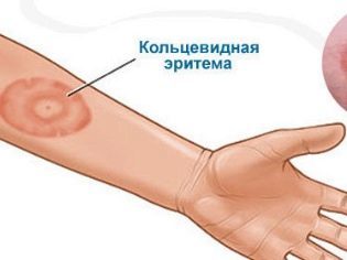 Эритема у детей и взрослых: симптомы, фото, лечение