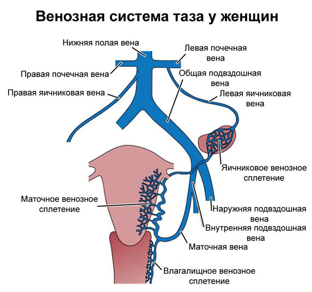 Варикозное расширение вен малого таза у женщин
