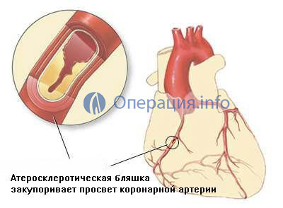 Коронарное шунтирование сосудов сердца - операция