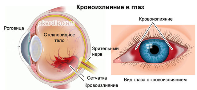 Кровь в глазном яблоке - Лечение глаз