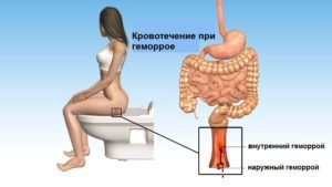 Кровотечение из заднего прохода без боли при стуле: причины и лечение