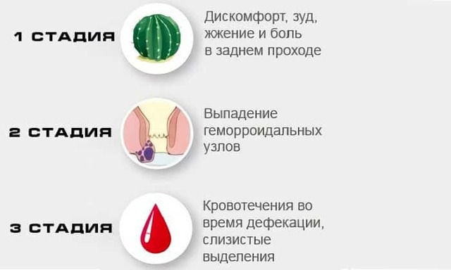Геморрой - причины, симптомы, диагностика и лечение