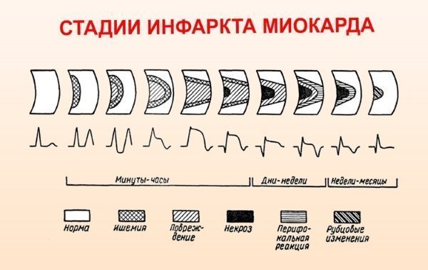Сколько инфарктов может перенести человек - Боль в Сердце