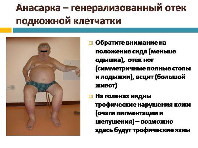 Отеки при сердечной недостаточности - патогенез, симптомы и лечение