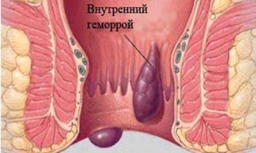 Внутренний геморрой лечение в домашних условиях