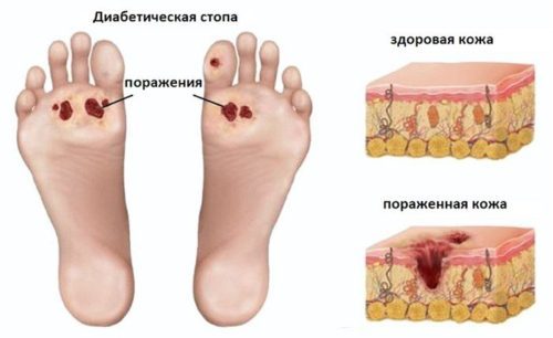 Осложнения сахарного диабета