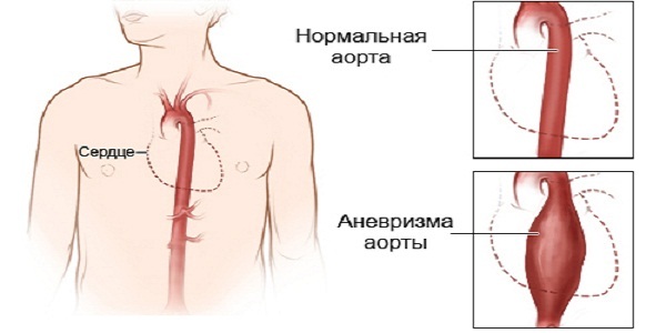 В области сердца тяжесть: причины и симптомы