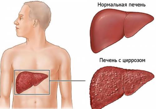 Мочевина в крови понижена: причины, что это значит, и как лечить