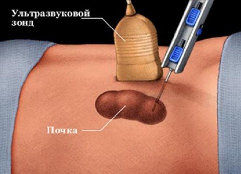 Киста почки - причины, признаки, симптомы и лечение