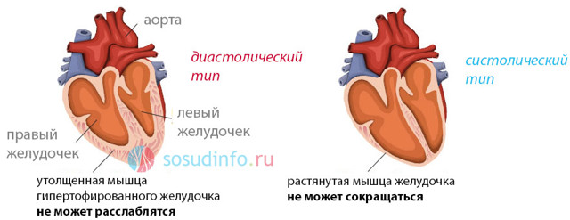 Систолическая жесткость сосудов и миокарда. Дисфункция предсердий и перегрузка объемом