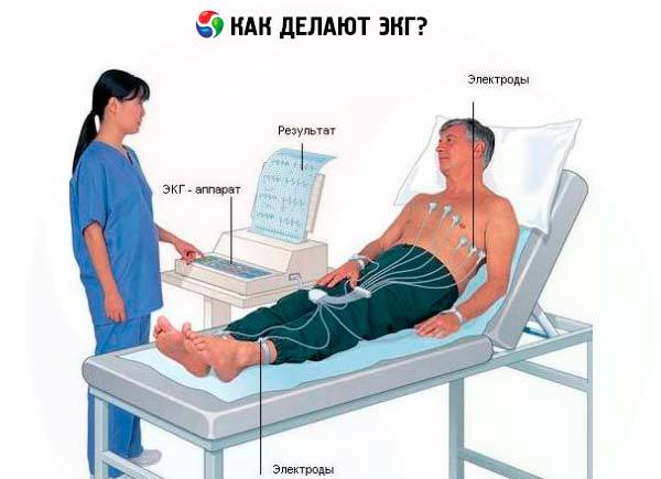 Инфаркт миокарда на ЭКГ: признаки, расшифровка