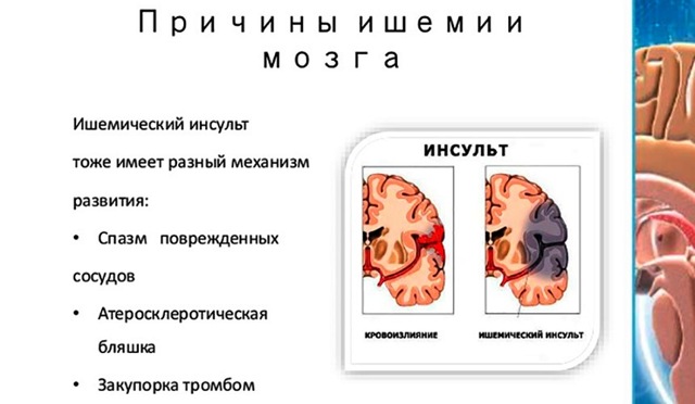 Ишемический инсульт головного мозга: прогноз для жизни у пожилых людей