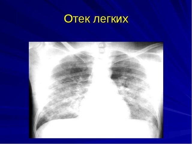Застой в легких при сердечной недостаточности