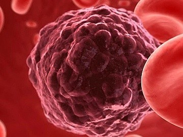 Особенности протекания и лечения миелоидного лейкоза