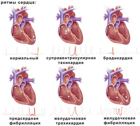 Синусовый ритм: что это в заключении ЭКГ, расшифровка и норма