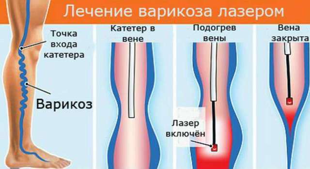 Лечение варикозного расширения вен нижних конечностей лазером на сайте варикоз