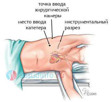 Радиочастотная абляция сердца (РЧА): что это такое, показания и противопоказания, реабилитация после операции
