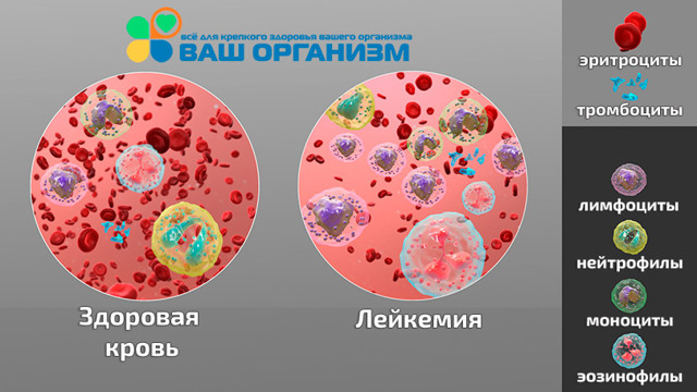 Лейкоз - злокачественное заболевание крови