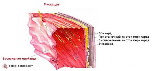 Классификация миокардитов по причинами, локализации, степени тяжести, течению