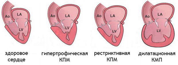Кардиомиопатия сердца: симптомы и лечение