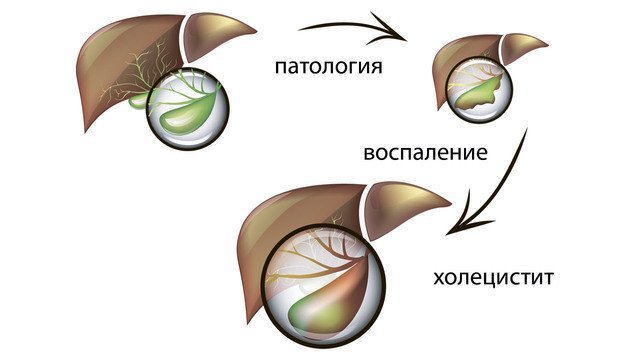 Хронический холецистит симптомы и лечение диета народные средства