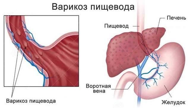 Варикозное расширение вен в желудке