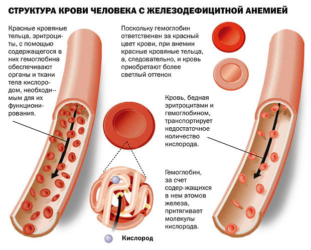 Анемия - формы, лечение, причины, симптомы, диагностика