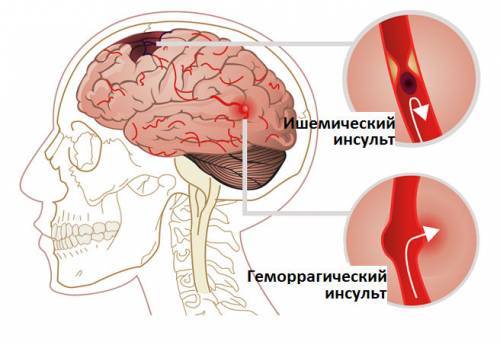От чего бывает инсульт и почему он происходит
