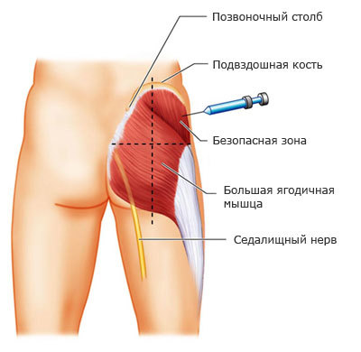 Как правильно и безопасно делать инъекции? Наглядная инструкция