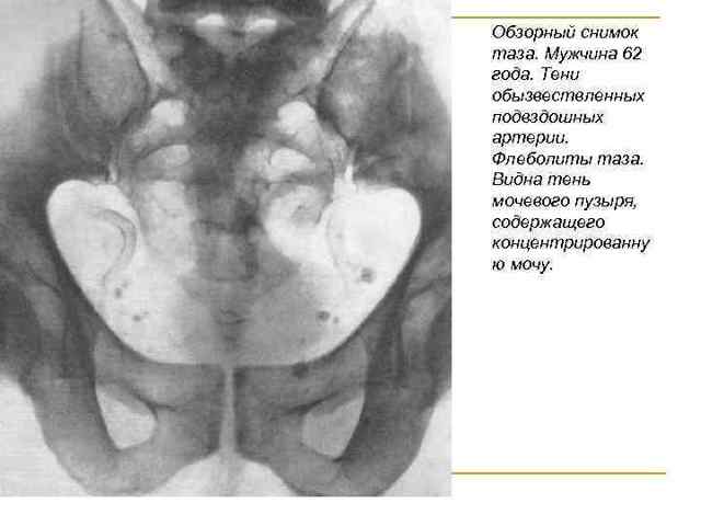 Флеболиты в малом тазу у мужчин - Все про холестерин