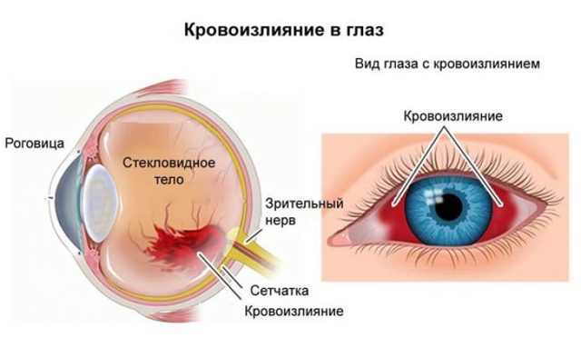 Кровоизлияние в глаз: лечение и причины