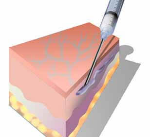 Осложнения и последствия после склеротерапии
