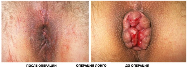 Удаление геморроидальных узлов с помощью разнообразных методик
