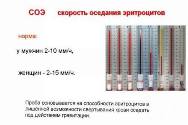Почему гемоглобин низкий соя высокая. Рак крови: сниженный гемоглобин и повышенный СОЭ