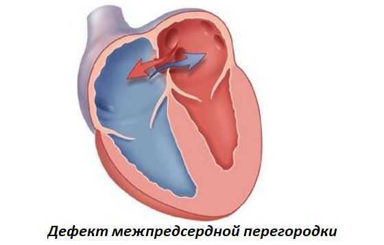 Блокада левой ножки пучка Гиса на ЭКГ (полная и неполная)