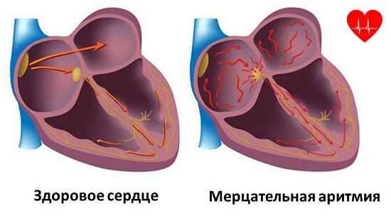 Признаки больного сердца - лечение болезней сердца и сосудов - Натуральная медицина